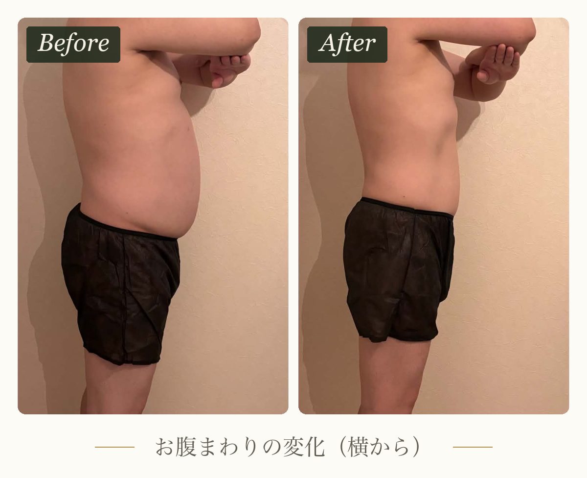 プログラムを受けたお客様のお腹まわりを横から見たビフォーアフター