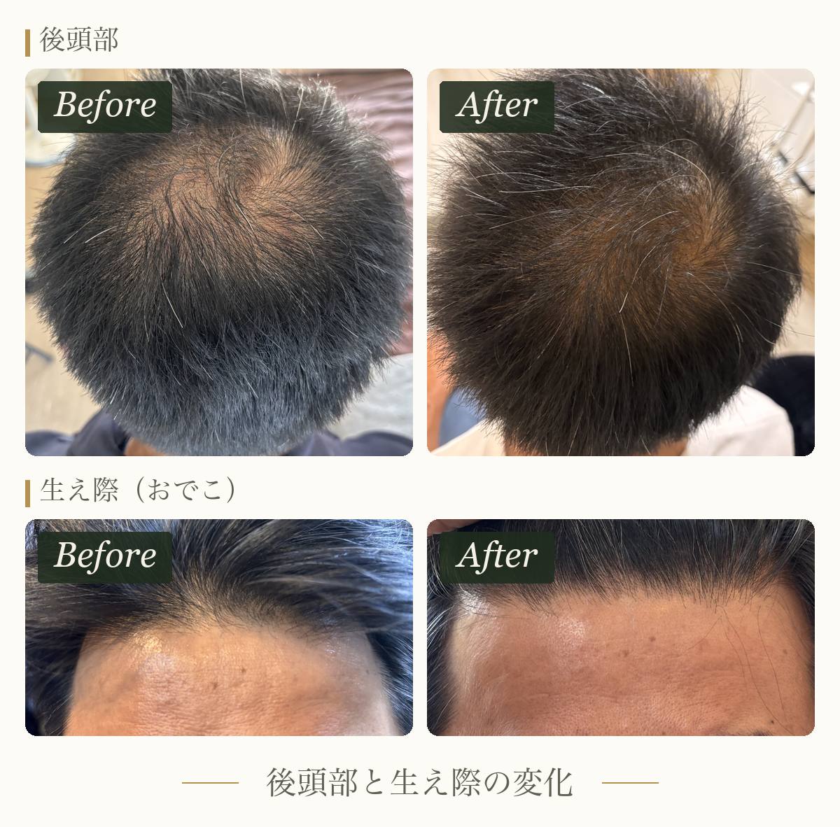 頭皮ケアを続けたお客様の後頭部と生え際のビフォーアフター